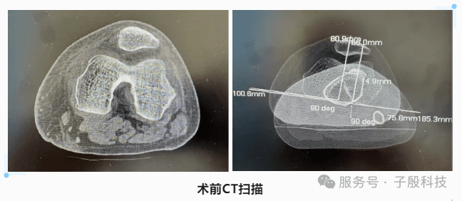 自治区首例3D打印导板精准定位下内侧髌股韧带重建术