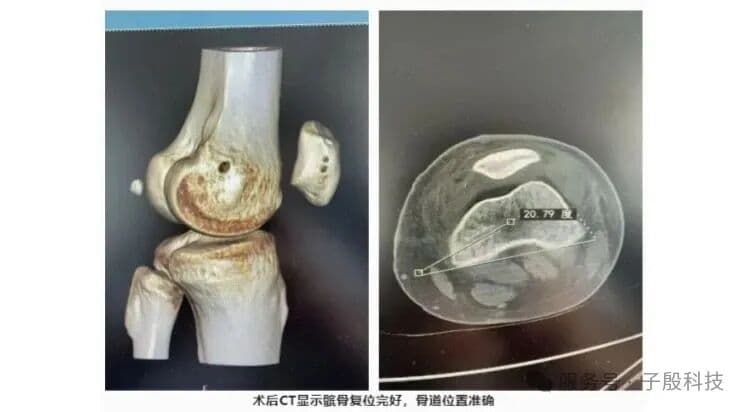 术后CT显示髌骨复位良好，骨道位置准确