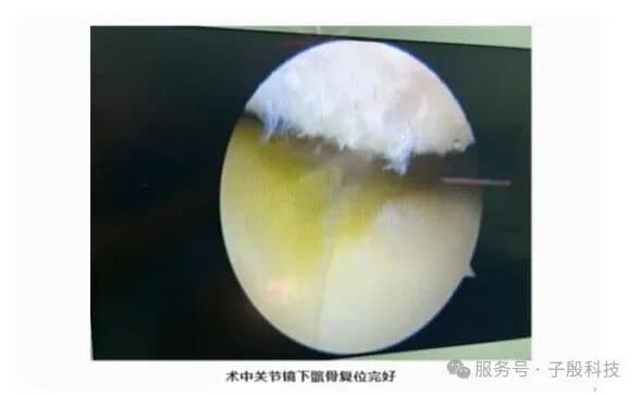 术中关节镜下髌骨复位完好