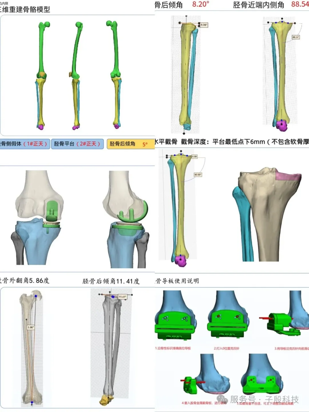 已公开的膝关节三维规划与个性化导板设计资料