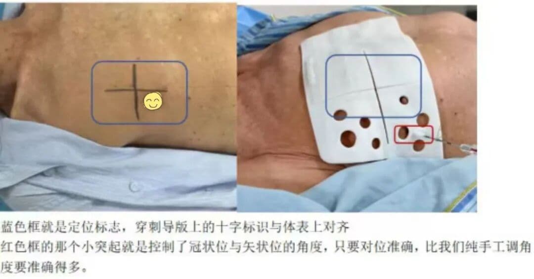 体表定位标记与个体化导板应用,院方原稿配图;图内说明为个案观察